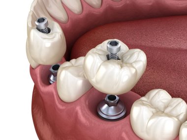 Azı dişi ve azı dişi yerleştirme implantın üzerine, vida saplantısı. Diş tedavisinin 3B illüstrasyonu
