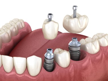Azı dişi ve azı dişi yerleştirme implantın üzerine, vida saplantısı. Diş tedavisinin 3B illüstrasyonu