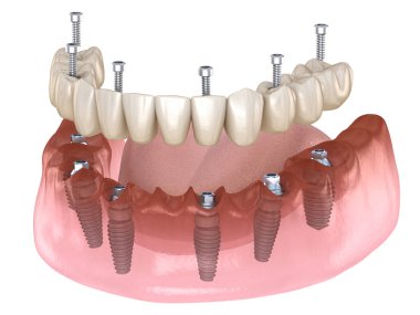 Alt çene protezi. Hepsi de implantlar ve vida saplantısıyla desteklenen 4 sistemde. Diş konseptinin tıbben doğru üç boyutlu çizimi