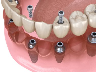 Alt çene protezi. Hepsi de implantlar ve vida saplantısıyla desteklenen 4 sistemde. Diş konseptinin tıbben doğru üç boyutlu çizimi