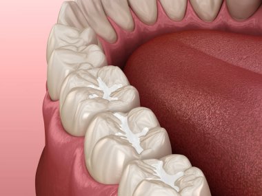 Molar Fissure diş dolguları, diş konseptinin tıbbi olarak doğru üç boyutlu çizimi