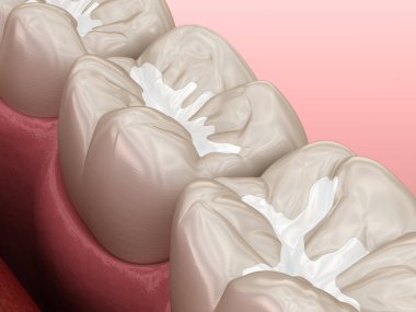 Molar Fissure diş dolguları, diş konseptinin tıbbi olarak doğru üç boyutlu çizimi