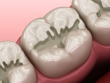 Doldurulmak için hazırlanmış Molar Fissure, diş konseptinin medikal olarak 3 boyutlu çizimi
