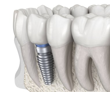 İmplantla azı dişi alınıyor. İnsan dişleri ve protez kavramının tıbben doğru üç boyutlu çizimi