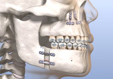 Maxillomandibular ilerlemiş ameliyat. Tıbbi olarak doğru olan 3 boyutlu diş illüstrasyonu.