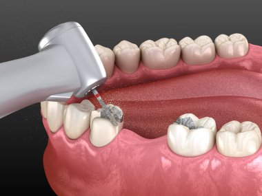 Amalgam çıkarılıyor ve seramik taç yerleştirme için hazırlanıyor. Diş konseptinin 3B illüstrasyonu