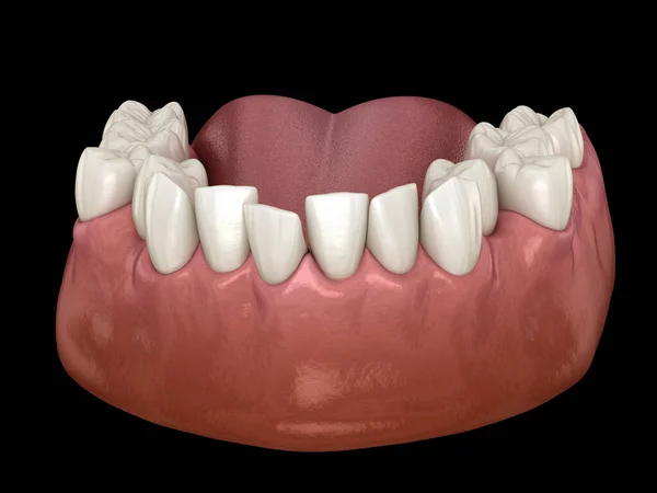 Overcrowded teeth, abnormal dental occlusion. Medically accurate tooth 3D illustration