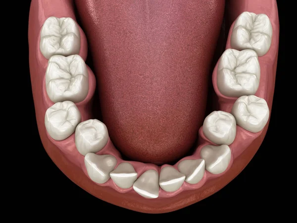 Dentes Superlotados Oclusão Dentária Anormal Ilustração Dente Medicamente Precisa — Fotografia de Stock