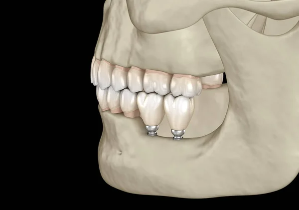 口腔颌骨植入小植入物 医学上准确的三维图像 — 图库照片