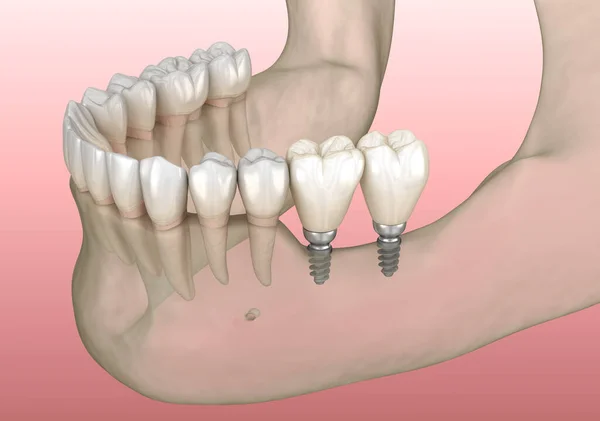 Implantação Com Mini Implantes Osso Mandíbula Embutido Ilustração Medicamente Precisa — Fotografia de Stock