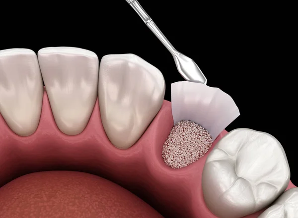 Cirurgia Aumento Adicionando Osso Após Extração Dentária Ilustração — Fotografia de Stock