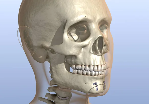 Χειρουργική Μείωση Πηγουνιού Οστεοπλαστική Osseous Genioplasty Ιατρικά Ακριβής Οδοντιατρική Τρισδιάστατη — Φωτογραφία Αρχείου