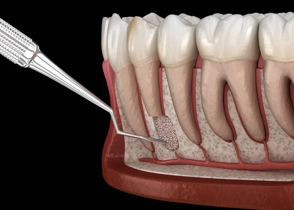 Chirurgia Cystektomii Zębów Rekonwalescencja Zapaleniu Okostnej Medycznie Dokładna Ilustracja — Zdjęcie stockowe