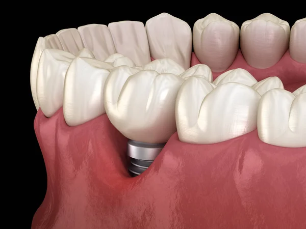 Peri Implantitis Visible Gum Recession Medically Accurate Illustration Dental Implants — Stock Photo, Image