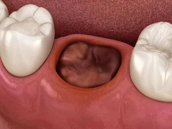 The blood clot seals off the tooth after extraction. Medically accurate 3D illustration