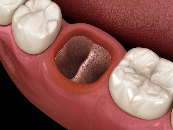 Альвеолиты - открытые сухие сокеты после удаления зубов. Медицинская точность 3D иллюстрации