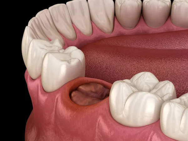 The blood clot seals off the tooth after extraction. Medically accurate 3D illustration