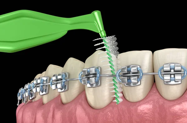 Interdental Tooth Brush Braces Cleaning Medically Accurate Illustration Oral Hygiene — Stock Photo, Image