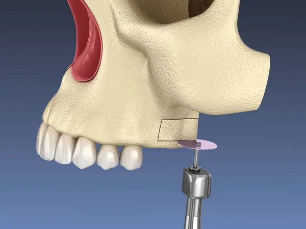 Sinus Lift Surgery Створення Стороннього Доступу Sinus Ілюстрація — стокове фото