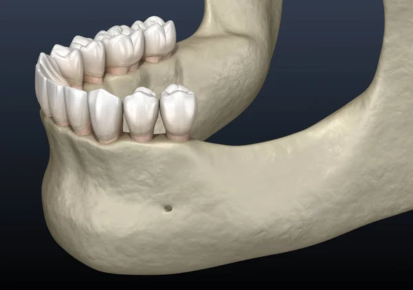 Mandibulární Čelist Kostní Recese Ztrátě Zubů Lékařsky Přesná Zubní Ilustrace — Stock fotografie