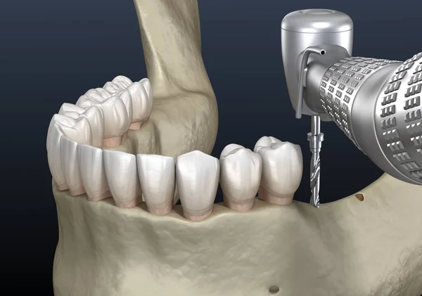 Alveolar Sırt Dekoltesi Büyütme Diş Cerrahisi Boyutlu Illüstrasyon — Stok fotoğraf