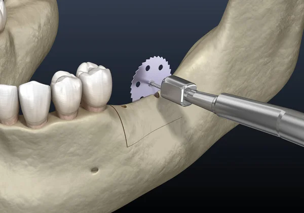 Escisión Cresta Alveolar Aumento Cirugía Dental Ilustración — Foto de Stock