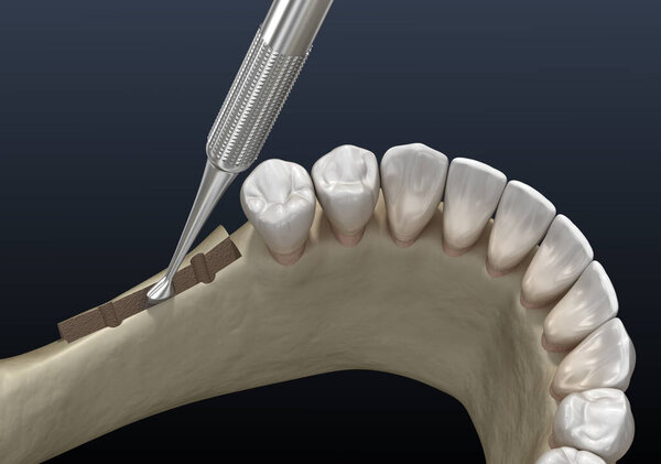 Cleavage of the alveolar ridge, augmentation. Dental surgery, 3D illustration