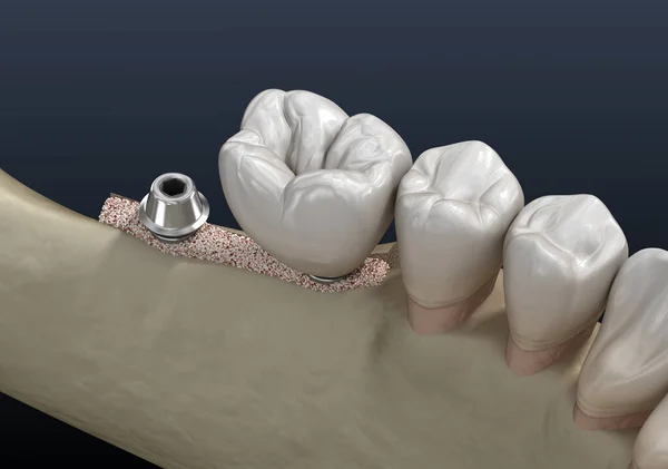 Decote Crista Alveolar Implantação Cirurgia Dentária Ilustração — Fotografia de Stock