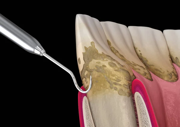 Oral hygiene: Scaling and root planing (conventional periodontal therapy). Medically accurate 3D illustration of human teeth treatment