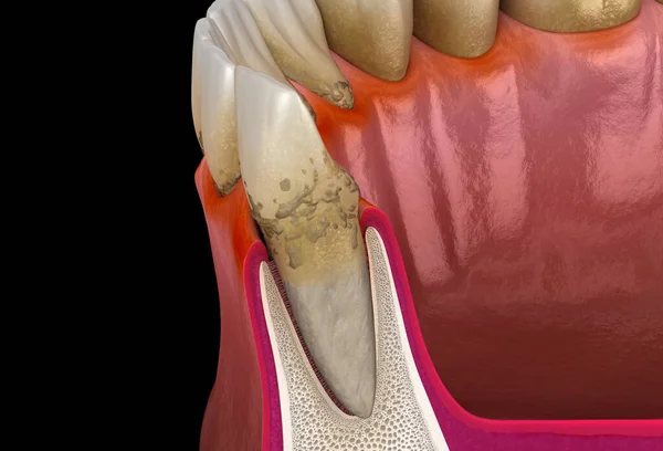 歯周炎ステージ2 歯茎の後退 タール 医学的に正確な3Dイラスト — ストック写真