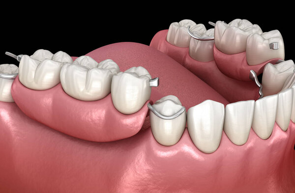 Removable partial denture, mandibular prosthesis. Medically accurate 3D illustration of prosthodontics concept