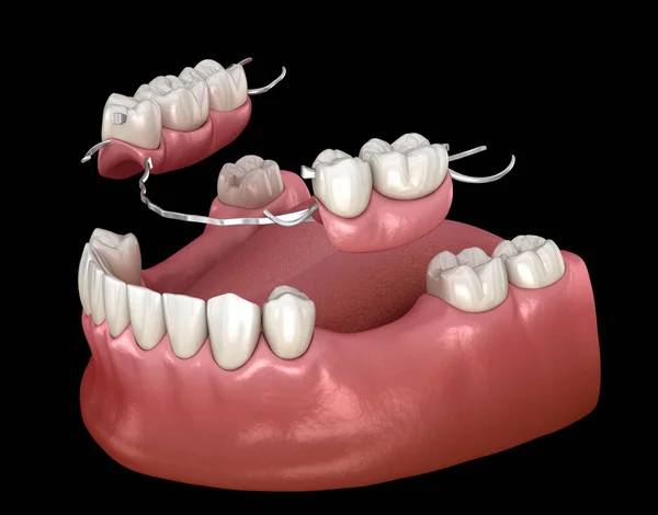 可摘除的局部假牙下颌骨假牙假牙概念的医学上准确的3D说明 — 图库照片