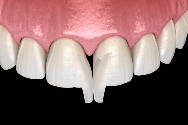 Diastema Behandeling Micro Fineer Installatie Procedure Centrale Snijtand Medisch Nauwkeurige — Stockfoto