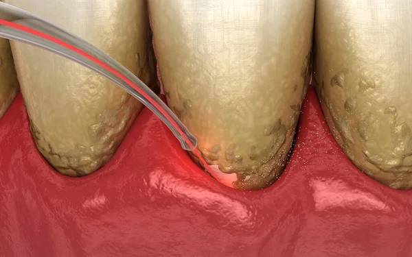 レーザーは 感染した皮膚 歯の洗浄のタールと薄い層を削除します 医学的に正確な歯3Dイラスト — ストック写真