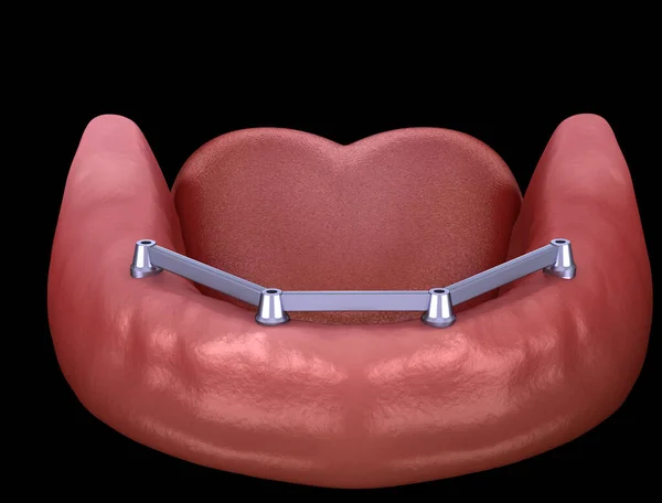 インプラントでサポートされている4つのシステム上のすべてのガムで取り外し可能な顎関節 人間の歯と入れ歯の医学的に正確な3Dイラスト — ストック写真