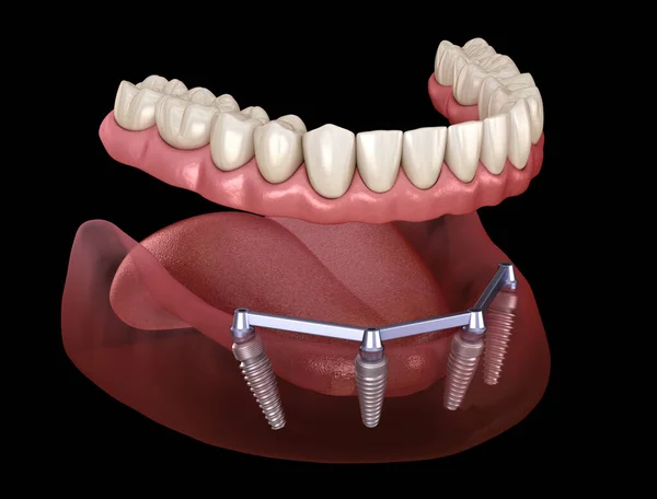 在4个系统上由植入物支持的带牙龈的可摘除下颌骨假体 医学上准确的人类牙齿和假牙3D图像 — 图库照片