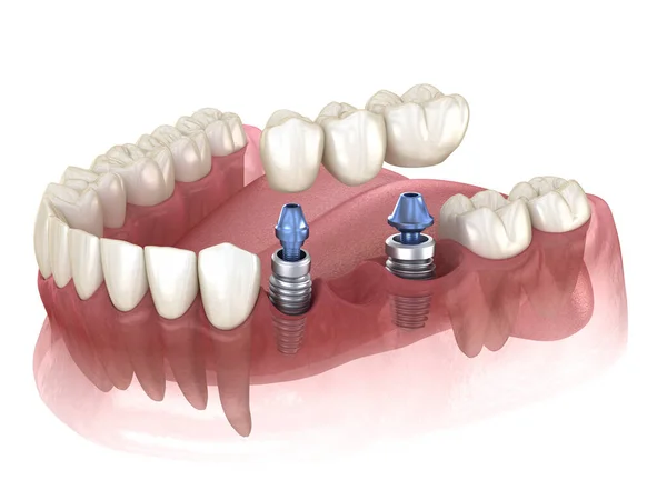 Ponte Dentale Sostenuto Impianti Illustrazione Clinicamente Accurata Del Concetto Denti — Foto Stock