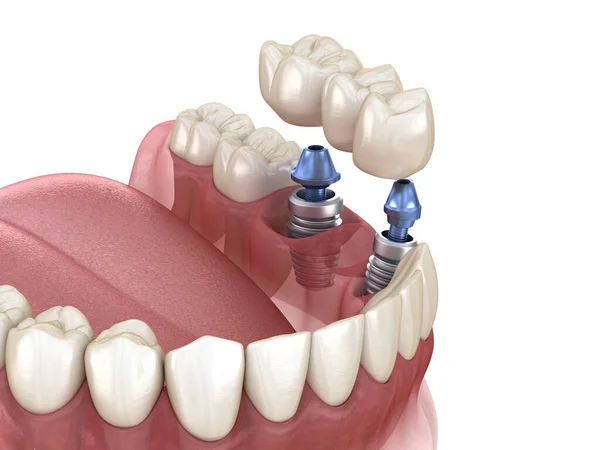 Tandheelkundige Brug Ondersteund Door Implantaten Medisch Nauwkeurige Illustratie Van Menselijke — Stockfoto