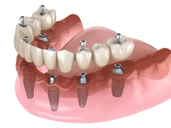 Prothèse Mandibulaire Tout Sur Système Soutenu Par Des Implants Fixation — Photo