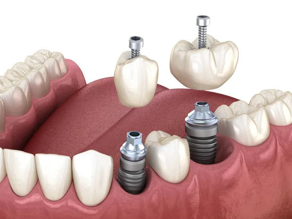 前磨牙及磨牙冠安装在种植体上 螺钉固定 牙科治疗的3D图解 — 图库照片