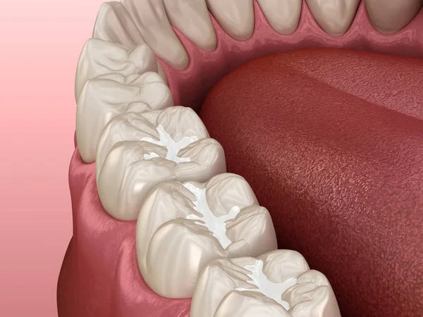 Remplissages Dentaires Molar Fissure Illustration Médicalement Précise Concept Dentaire — Photo