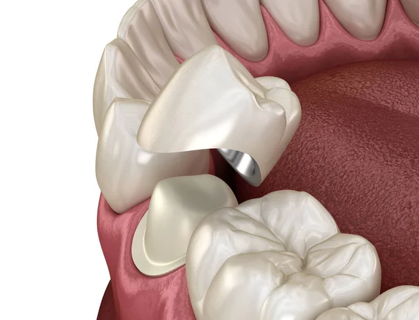 Προγόμφιος Οδοντίατρος Και Οδοντιατρική Μεταλλική Κεραμική Κορώνα Ιατρικά Ακριβής Τρισδιάστατη — Φωτογραφία Αρχείου