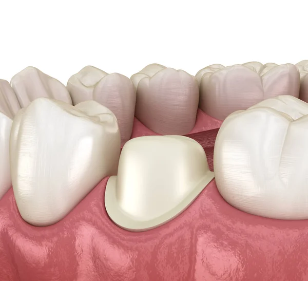 Dente Premolare Preparato Posizionamento Corona Metallo Ceramica Dentale Illustrazione Clinicamente — Foto Stock