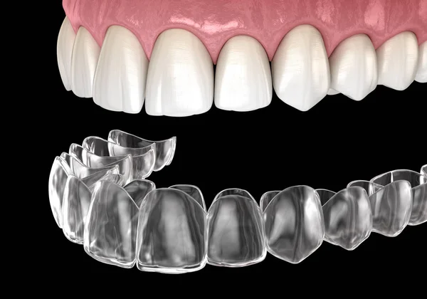 Bretelle Invisalign Fermo Invisibile Illustrazione Dentale Clinicamente Accurata — Foto Stock