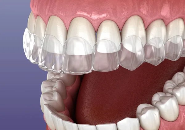 Bretelle Invisalign Fermo Invisibile Illustrazione Dentale Clinicamente Accurata — Foto Stock