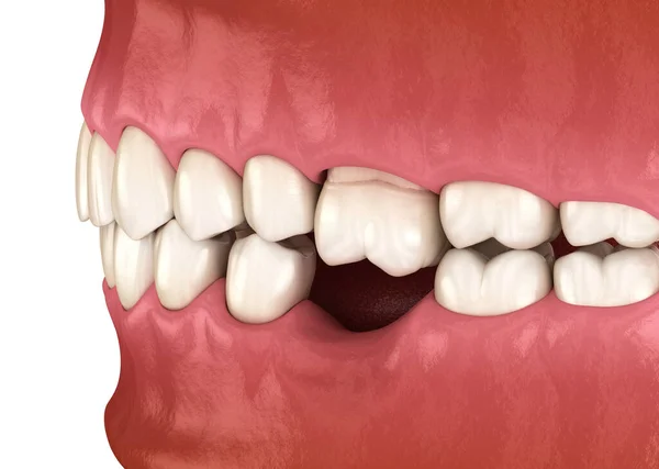 磨牙脱落后 牙齿移位畸形 Popov Godon现象的3D图解 — 图库照片