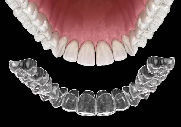 Braçadeiras Invasoras Retentor Invisível Ilustração Odontológica Medicamente Precisa — Fotografia de Stock