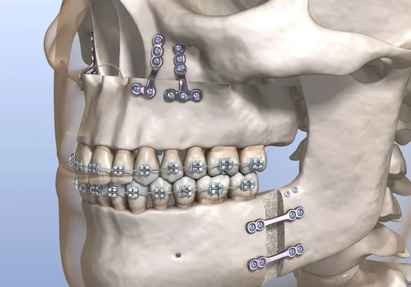 Maxillomandibular Ilerlemiş Ameliyat Tıbbi Olarak Doğru Olan Boyutlu Diş Illüstrasyonu — Stok fotoğraf