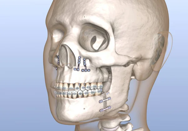 Maxillomandibular Advancement Surgery Lékařsky Přesná Zubní Ilustrace — Stock fotografie