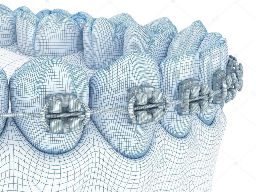 Braces and denture. Wire 3d model illustration